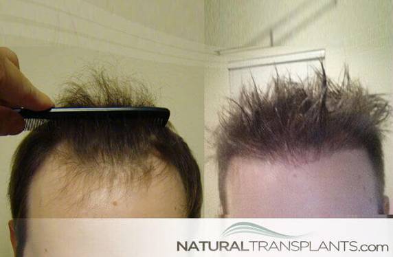 Natural Transplants, Hair Restoration Clinic | 1228 E 7th Ave #200, Tampa, FL 33605 | Phone: (813) 440-2598