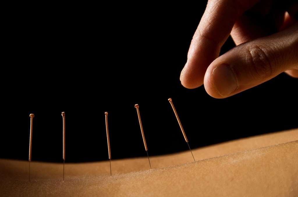 Complete Care Acupuncture and Wellness | 1641 State Route 3 North, #203, Crofton, MD 21114, USA | Phone: (410) 697-1235