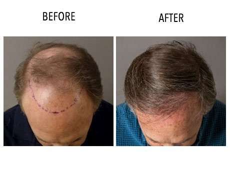 Capri Hair Restoration | 2813 Bristol Pike, Bensalem, PA 19020, USA | Phone: (877) 602-2774