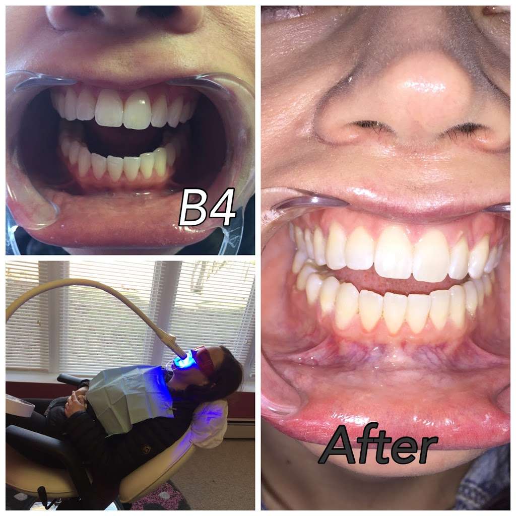 Teeth whitening beauty services | 100 W West Dr, Northlake, IL 60164, USA | Phone: (708) 890-1176