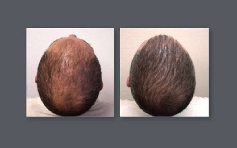 Virginia Hair Transplant | 19440 Golf Vista Plaza #130, Leesburg, VA 20176, USA | Phone: (866) 723-5373