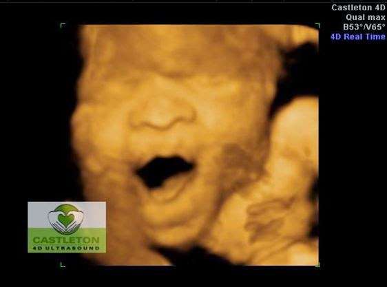 Castleton HD Ultrasound LLC | 7035 E 96th St Ste G, Indianapolis, IN 46250 | Phone: (317) 578-0442