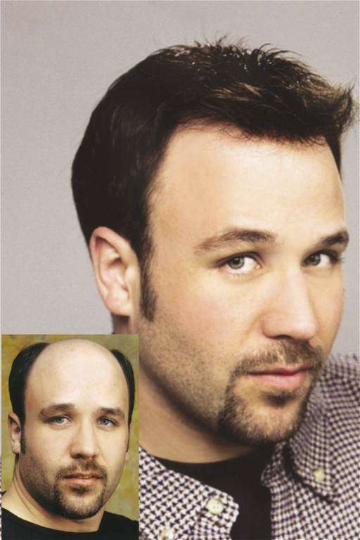 Indy Hair Loss | 2995 E Troy Ave, Beech Grove, IN 46107, USA | Phone: (317) 440-9355