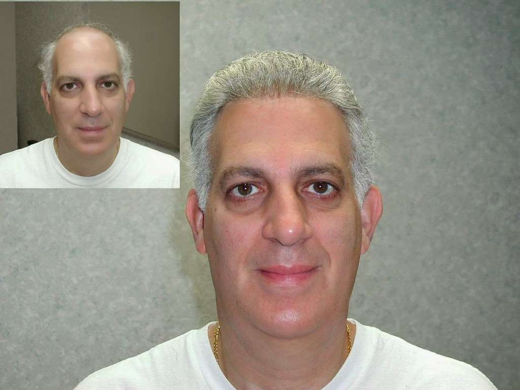 Manny Roberts Hair Replacement | 4 Expy Plaza Ll14, Roslyn Heights, NY 11577 | Phone: (800) 456-4247