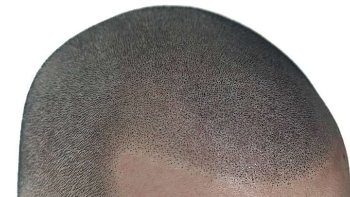 Picasso Scalp Micropigmentation - Chicago | 7550 Archer Rd unit b, Justice, IL 60458 | Phone: (480) 547-6246