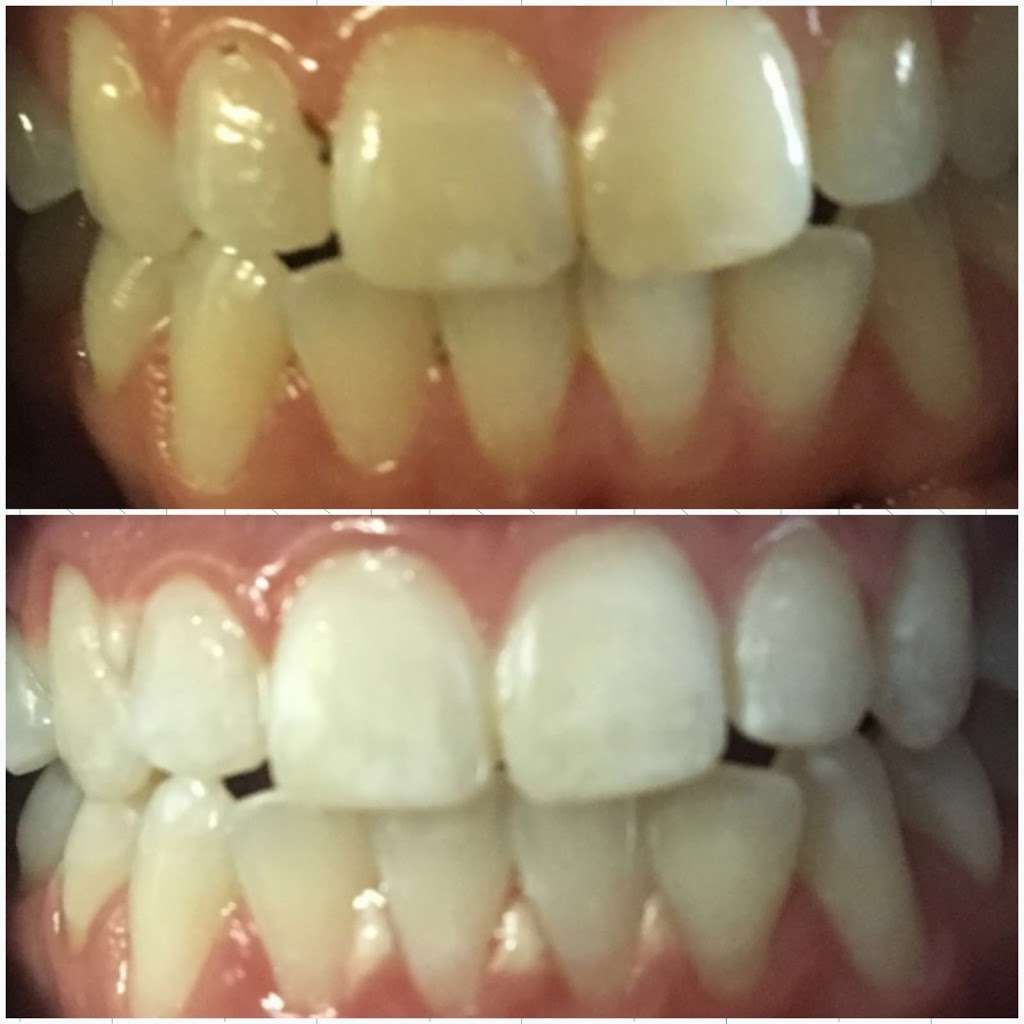 Yevonne’s laser teeth whitening LLC | 4933 S Carson St APT 212, Aurora, CO 80015 | Phone: (720) 629-9030