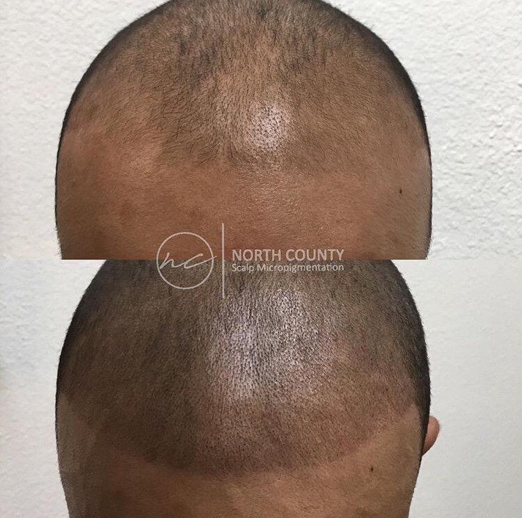 North County Scalp Micropigmentation | 1172, 1822 Marron Rd, Carlsbad, CA 92008, USA | Phone: (760) 805-6801