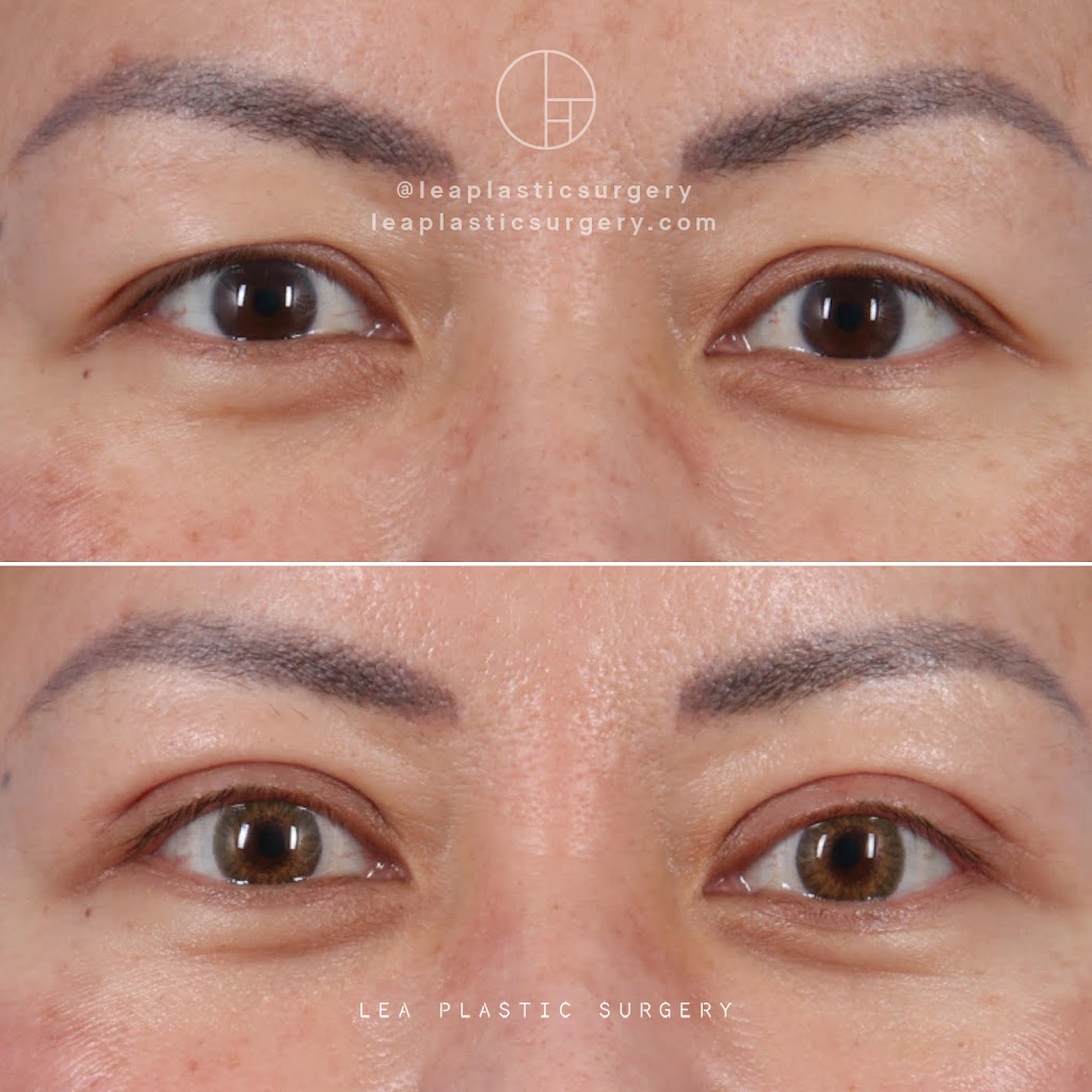 LEA Plastic Surgery - Goretti Ho Taghva MD, FACS | 20360 SW Birch St #180, Newport Beach, CA 92660, USA | Phone: (949) 945-2168