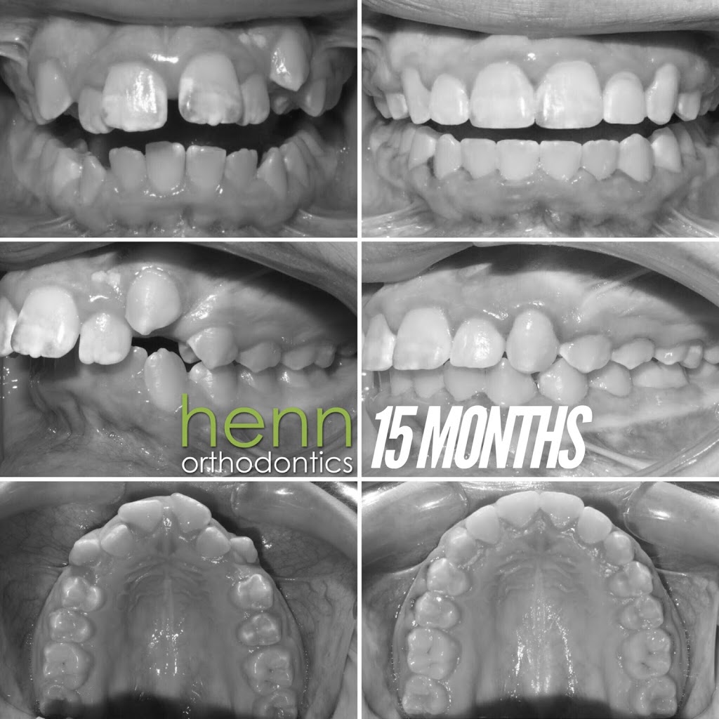 Henn Orthodontics | 4816 Greenwood Rd, Louisville, KY 40258, USA | Phone: (502) 935-7212