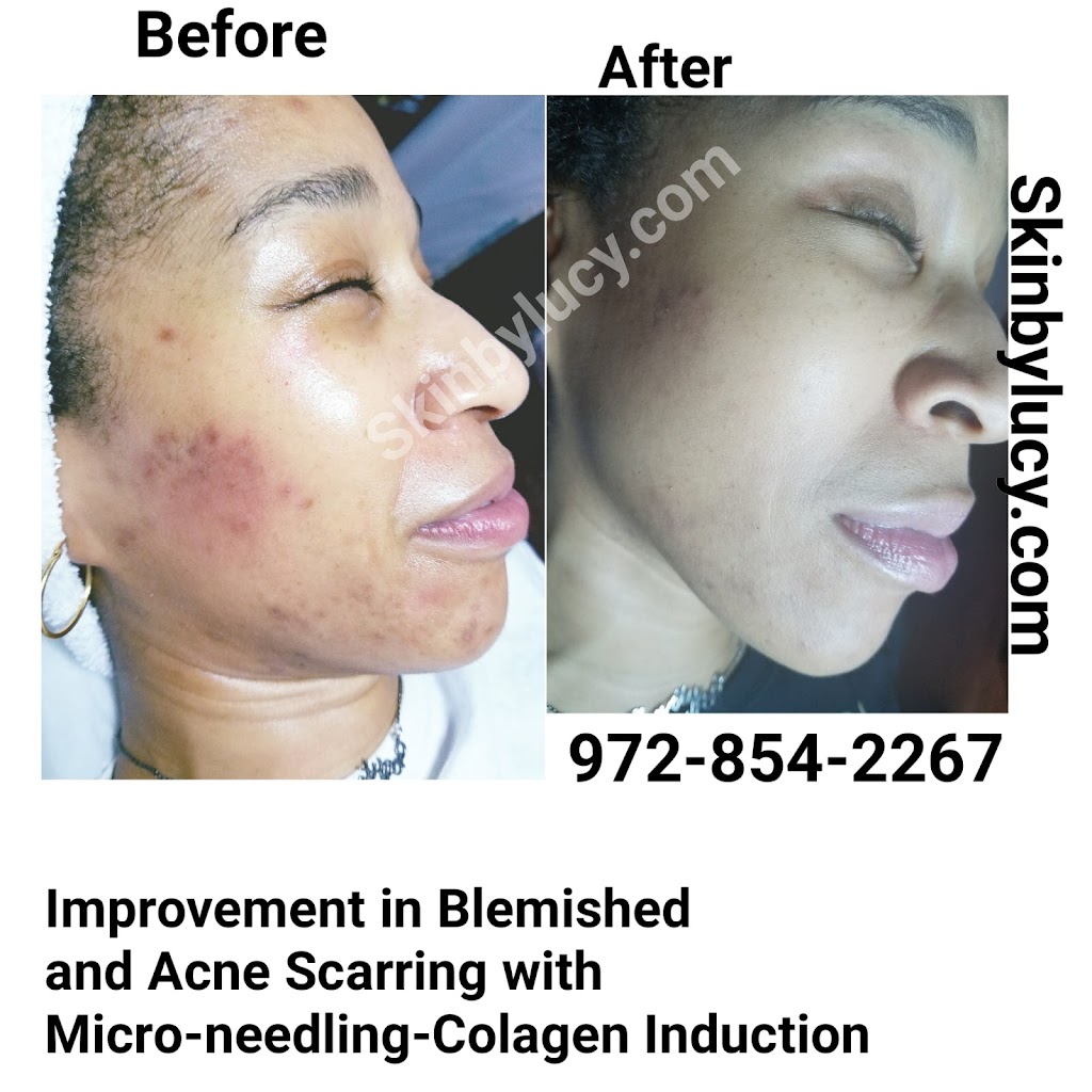 Skin by Lucy Med | 4222 Trinity Mills Rd, Dallas, TX 75287, USA | Phone: (972) 854-2267