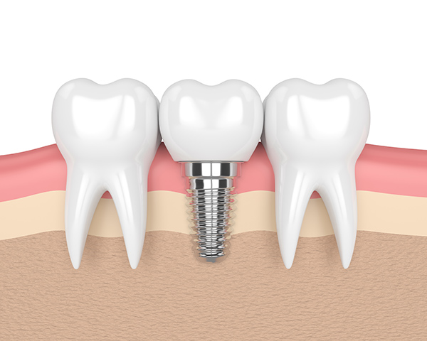Clear Dental Studio | 645 Flatiron Marketplace Dr A, Broomfield, CO 80021, USA | Phone: (303) 321-3040