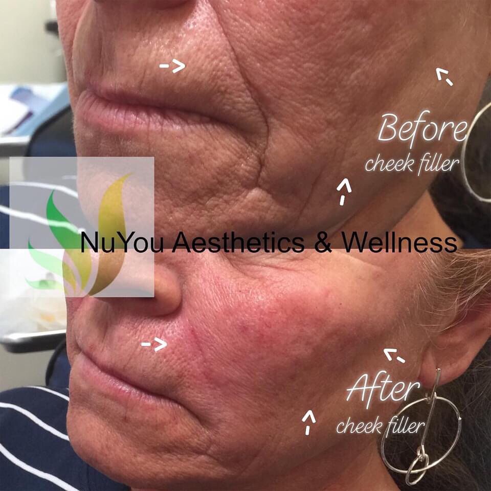 NuYou Aesthetics and Wellness MedSpa | 2721 Fairview Blvd Suite 106, Fairview, TN 37062 | Phone: (615) 266-2178