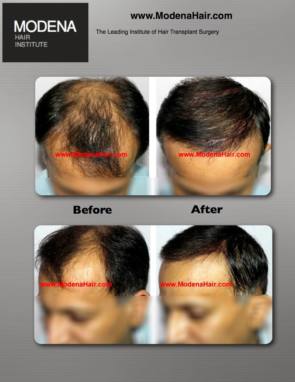 Modena Hair Transplant Institute | 2629 W Horizon Ridge Pkwy Suite #110, Henderson, NV 89052, USA | Phone: (702) 966-5134 Modena Hair Transplant Institute | 2629 W Horizon Ridge Pkwy Suite #110, Henderson, NV 89052, USA | Phone: (702) 966-5134