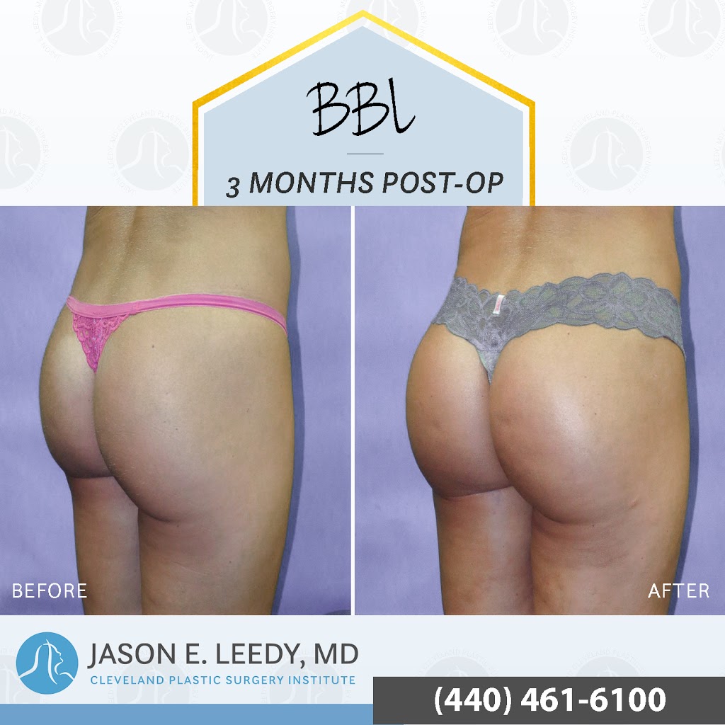 Cleveland Plastic Surgery Institute: Jason Leedy, MD | 2060 Lander Rd, Mayfield Heights, OH 44124, USA | Phone: (440) 461-6100