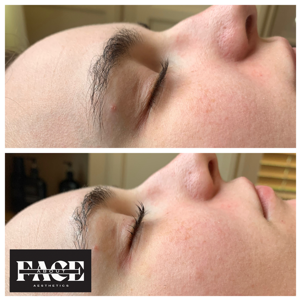 About Face Aesthetics | Studio 12, 588 N Lincoln Ave, Loveland, CO 80537, USA | Phone: (970) 744-3064 About Face Aesthetics | Studio 12, 588 N Lincoln Ave, Loveland, CO 80537, USA | Phone: (970) 744-3064