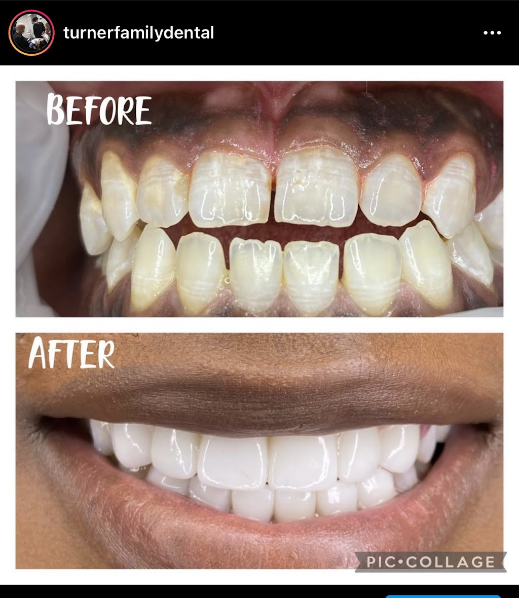 Turner Family Dental | 3450 Bainbridge Dr #570, Dallas, TX 75237, USA | Phone: (972) 709-7414