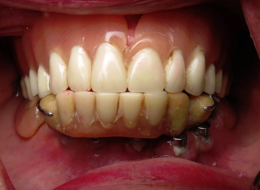 Burbank Dental Implants: Ramsey A. Amin D.D.S. | 500 E Olive Ave #520, Burbank, CA 91501, USA | Phone: (818) 846-3203