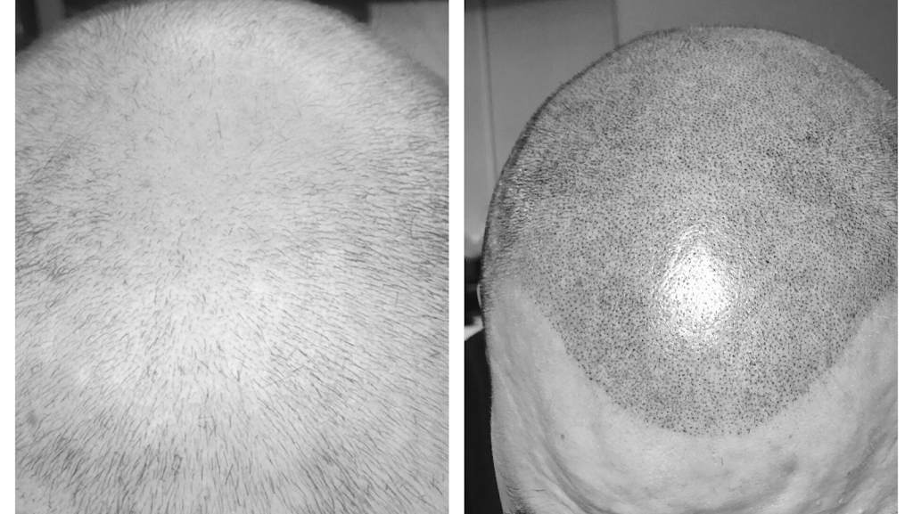 Scalp Renewal | 727 Muller Rd, Westminster, MD 21157, USA | Phone: (443) 562-5520