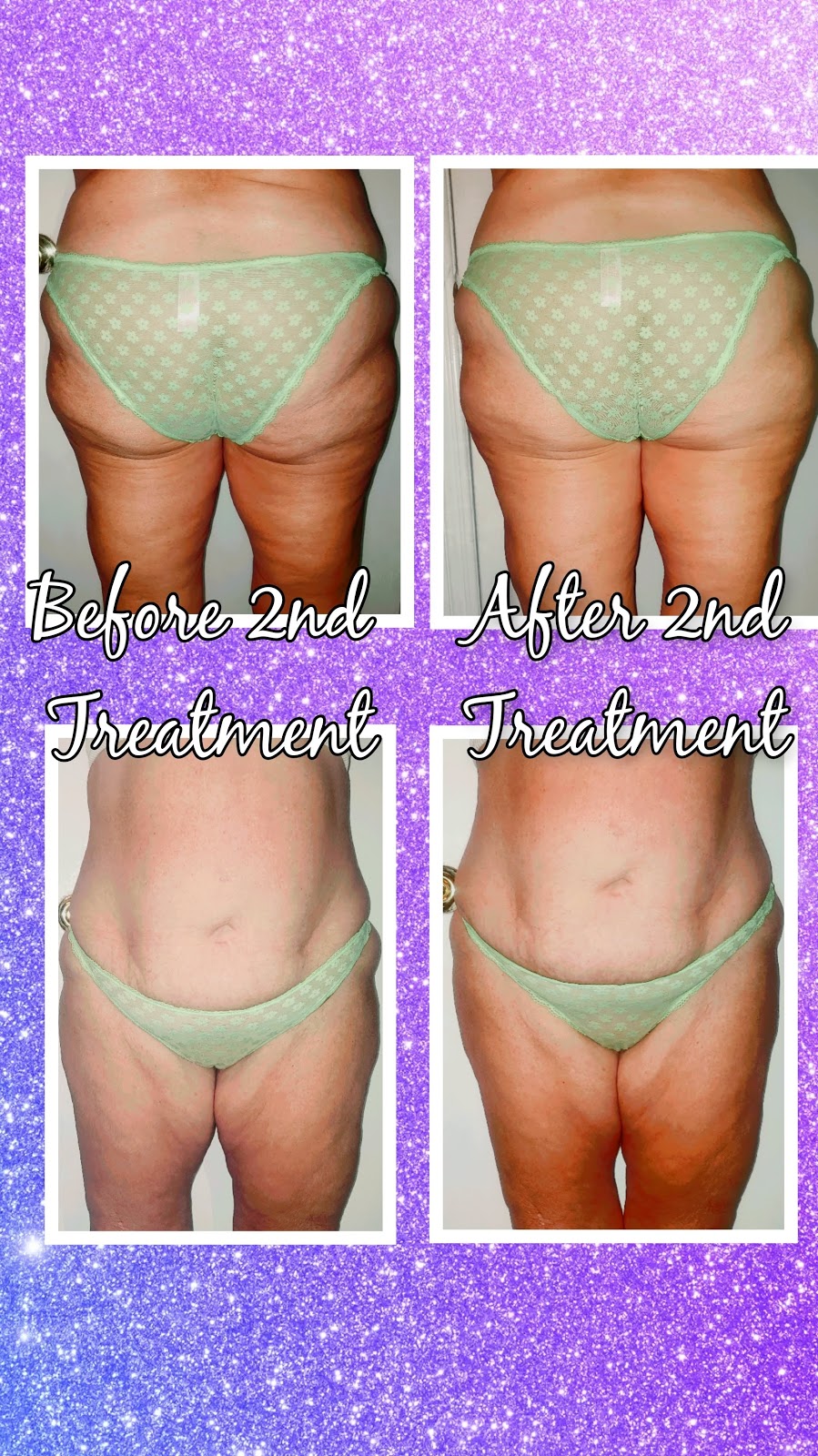 Pure Sass Body Contouring | 34265 Yucaipa Blvd, Yucaipa, CA 92399, USA | Phone: (909) 961-6005