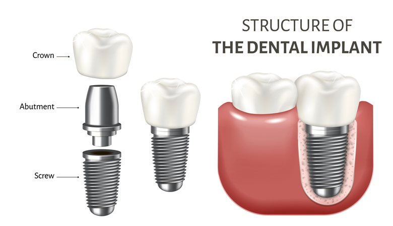 Dr. De G. Nguyen D.D.S. Dental Implant- Alhambra Cosmetic Dentistry | 841 W Valley Blvd #105, Alhambra, CA 91803, USA | Phone: (626) 576-1415