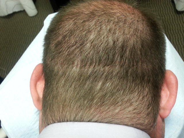 DermiMatch Scalp Micropigmentation | 7320 E Deer Valley Rd Suite 100-A, Scottsdale, AZ 85255, USA | Phone: (480) 788-2432