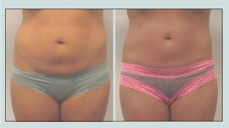 UltraSlim Atlanta Body Contouring | 1595 Kennesaw Due West Rd NW, Kennesaw, GA 30152, USA | Phone: (470) 308-3365