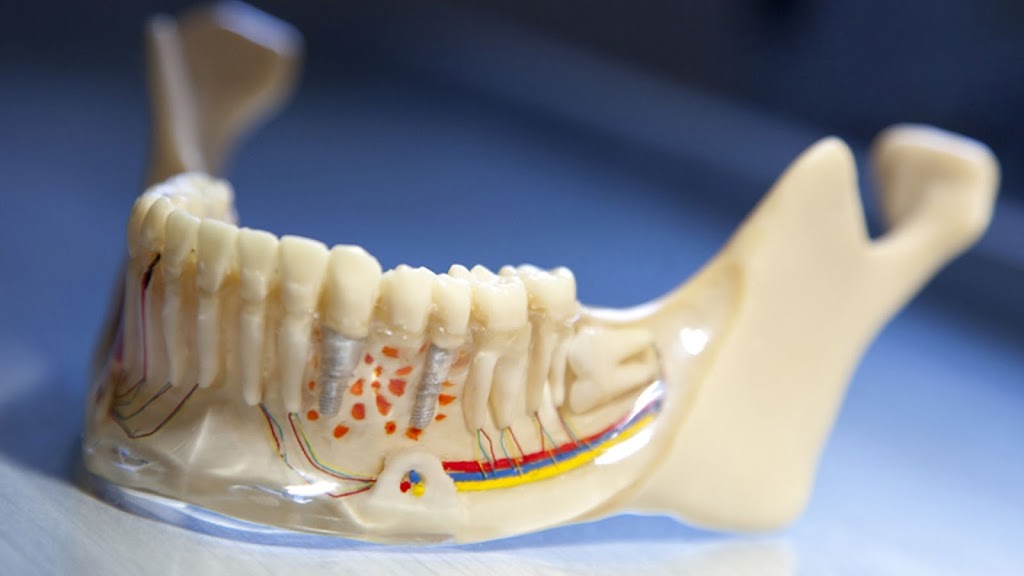 Dental Implants Albany | 505 Bradford St, Albany, NY 12206, USA | Phone: (518) 460-3047