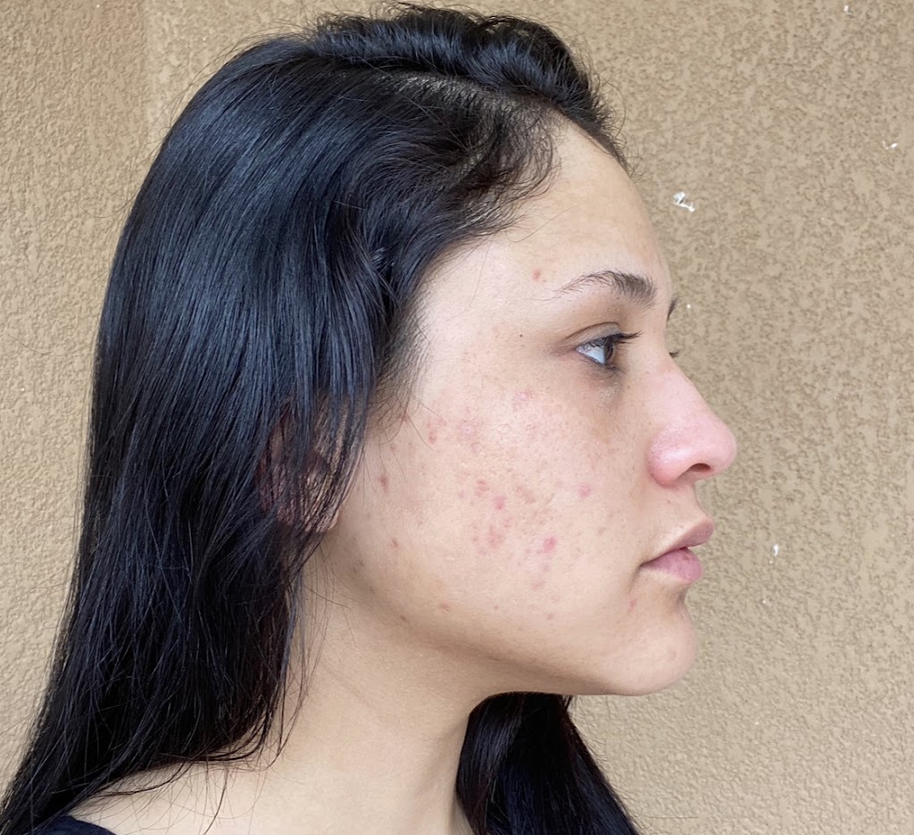 Glow DermSolutions San Jose | 6950 Santa Teresa Blvd STE E, San Jose, CA 95119, USA | Phone: (408) 794-5503 Glow DermSolutions San Jose | 6950 Santa Teresa Blvd STE E, San Jose, CA 95119, USA | Phone: (408) 794-5503