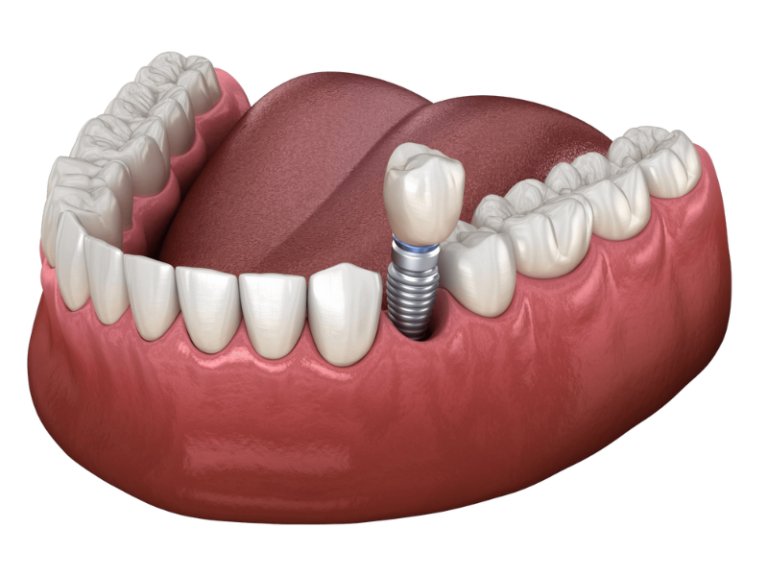 ProSmile Dental Implant Center | 14287 N 87th St STE 120, Scottsdale, AZ 85260, United States | Phone: (480) 878-7717