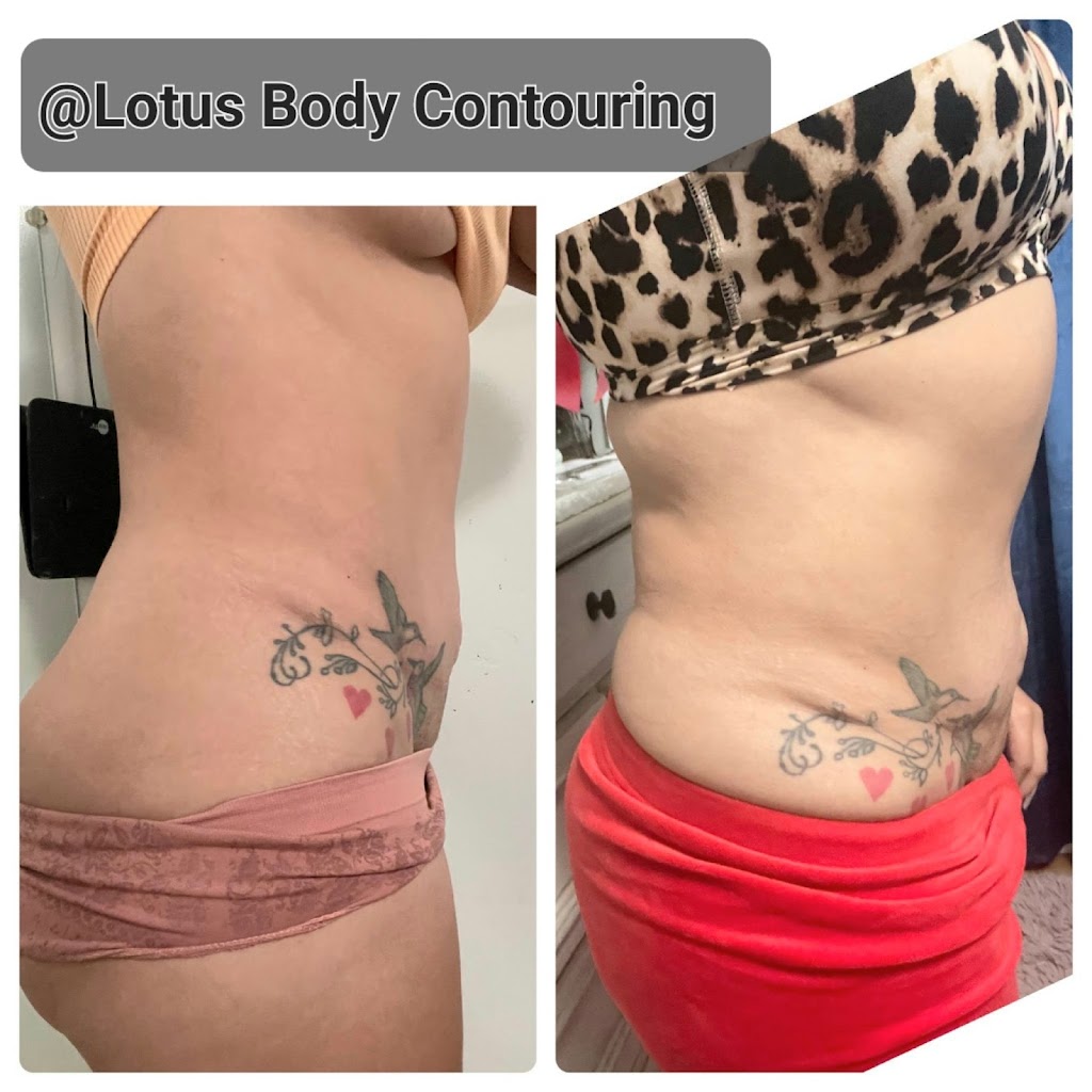 Lotus Body Contouring & Post-Lipo | 14442 Magnolia Blvd, Sherman Oaks, CA 91423, USA | Phone: (818) 310-0058