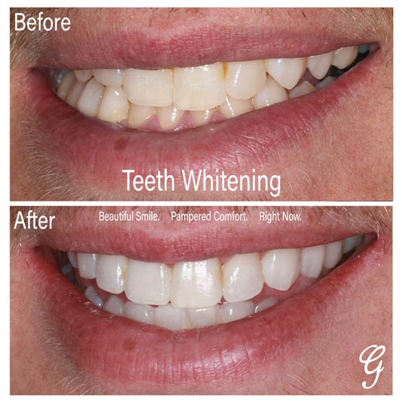 Gunnerson Dental | 33 W 300 S, Payson, UT 84651, United States | Phone: (801) 658-0175