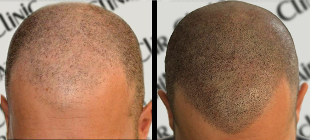 DermiMatch Scalp Micropigmentation | 7320 E Deer Valley Rd Suite 100-A, Scottsdale, AZ 85255, USA | Phone: (480) 788-2432