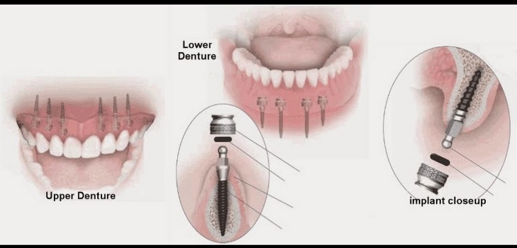 Mini Dental Implant Center | 120 Carter Blvd Suite 8, Polk City, FL 33868, USA | Phone: (863) 984-0000