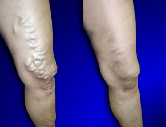 USA Vein Clinics | 6049 S Hulen St #101, Fort Worth, TX 76132, USA | Phone: (817) 672-2850