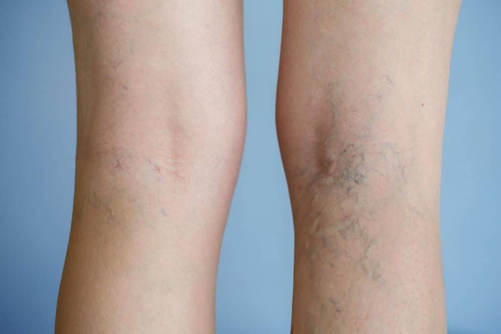 Bergen Vein Clinic | 385 Maple Ave Ste 101, Glen Rock, NJ 07452, USA | Phone: (551) 262-1800