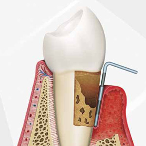 Southern Arizona Periodontics, P.L.C. | 403 W Cool Dr. Suite 101, Tucson, AZ 85704, USA | Phone: (520) 322-9300