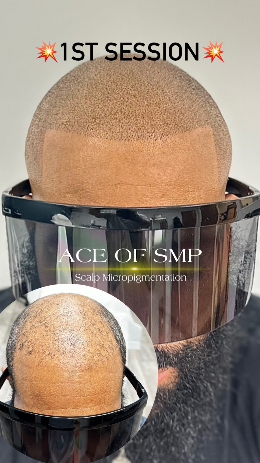 SCALP MICROPIGMENTATION | 2111 W Lincoln Hwy, Merrillville, IN 46410, USA | Phone: (630) 486-4502