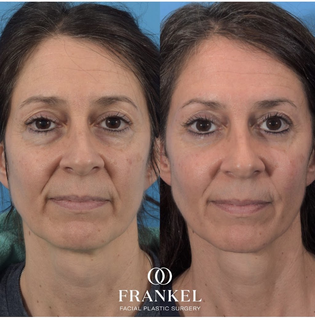 Frankel Facial Plastic Surgery, LLC: Jonathan Frankel, MD | 5885 Landerbrook Dr Suite 150, Mayfield Heights, OH 44124, USA | Phone: (216) 399-9550