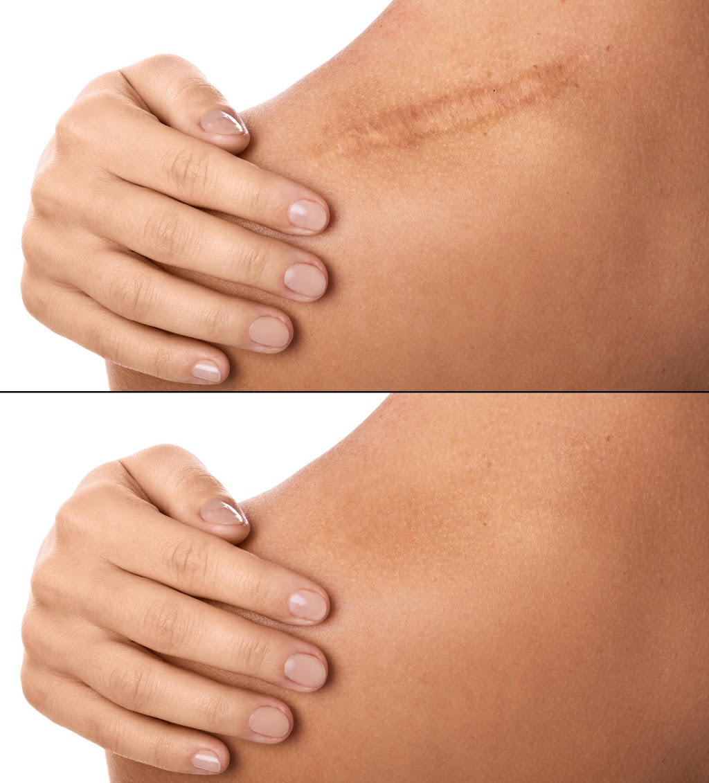 Fibroblast plasma lift | 445 S Associated Rd, Brea, CA 92821, USA | Phone: (714) 267-1388