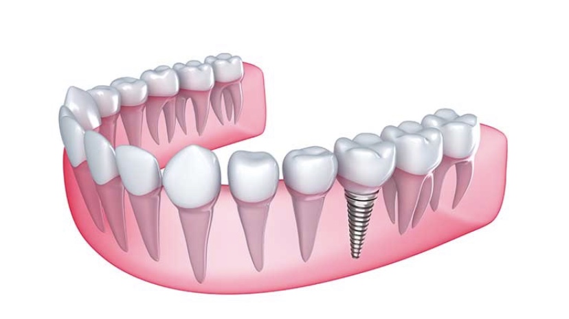 Signature Dental Care | 44274 George Cushman Ct #108, Temecula, CA 92592, USA | Phone: (951) 303-2803