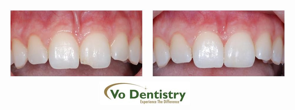 Vo Dentistry | 1605 Buford Dr, Lawrenceville, GA 30043, USA | Phone: (678) 985-8087