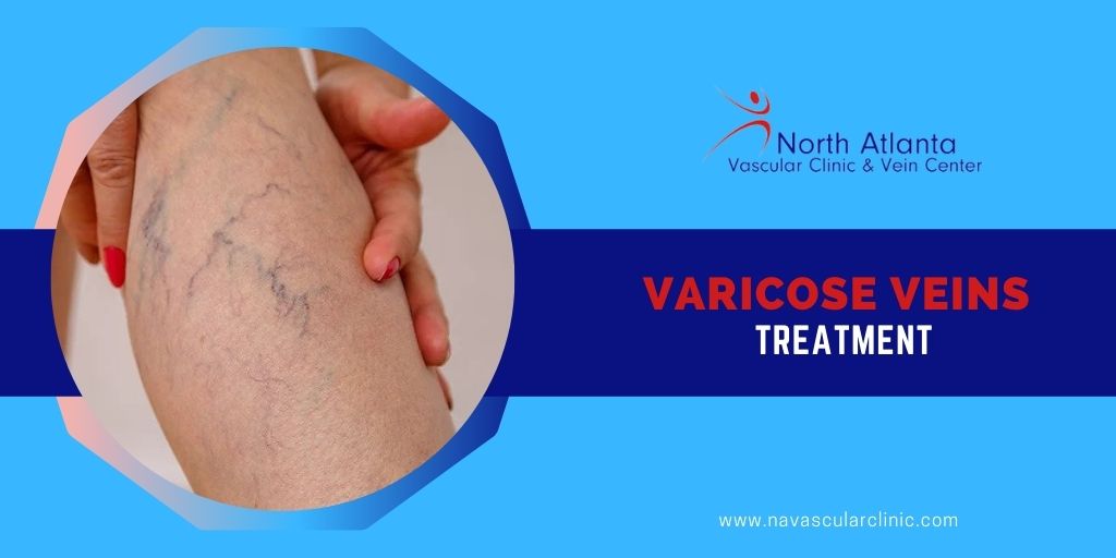 North Atlanta Vascular Clinic | 771 Old Norcross Rd Suite 300, Lawrenceville, GA 30046, USA | Phone: (770) 771-5260