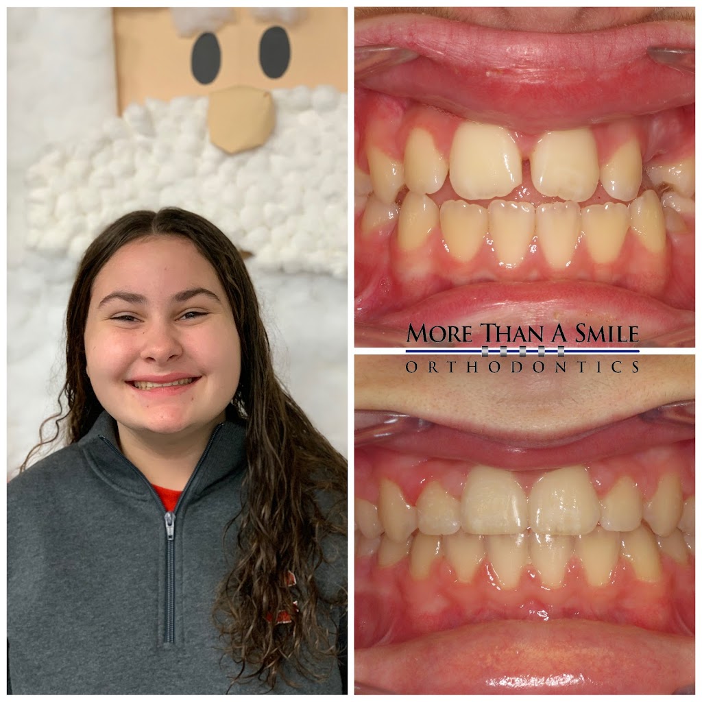 More Than A Smile Orthodontics | 2185 Bullis Rd, Elma, NY 14059, USA | Phone: (716) 652-0140