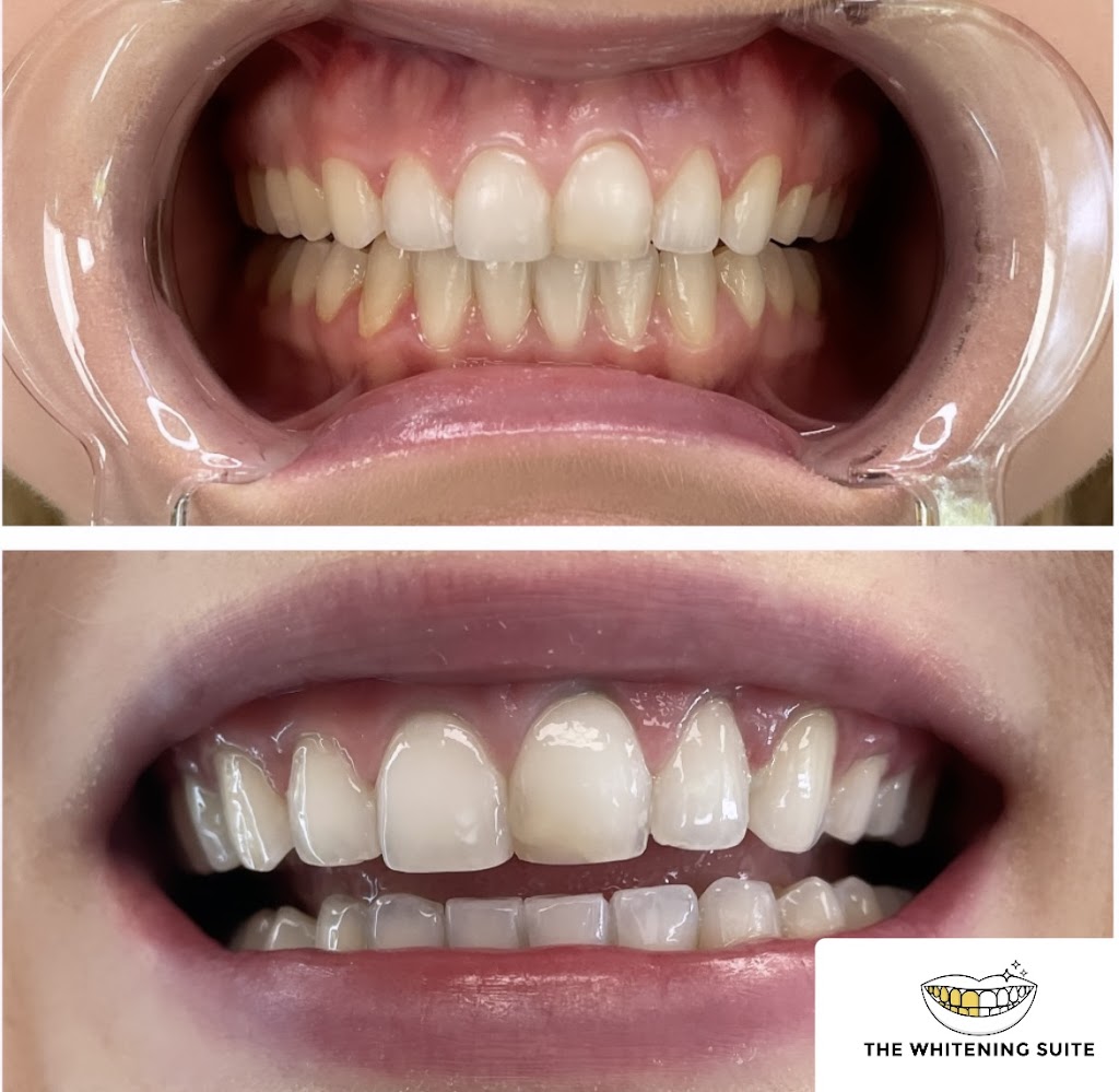 The Whitening Suite (Mobile Service only, We go to you) | 602 Mantoloking Rd Unit 2, Brick Township, NJ 08723, USA | Phone: (732) 859-7436