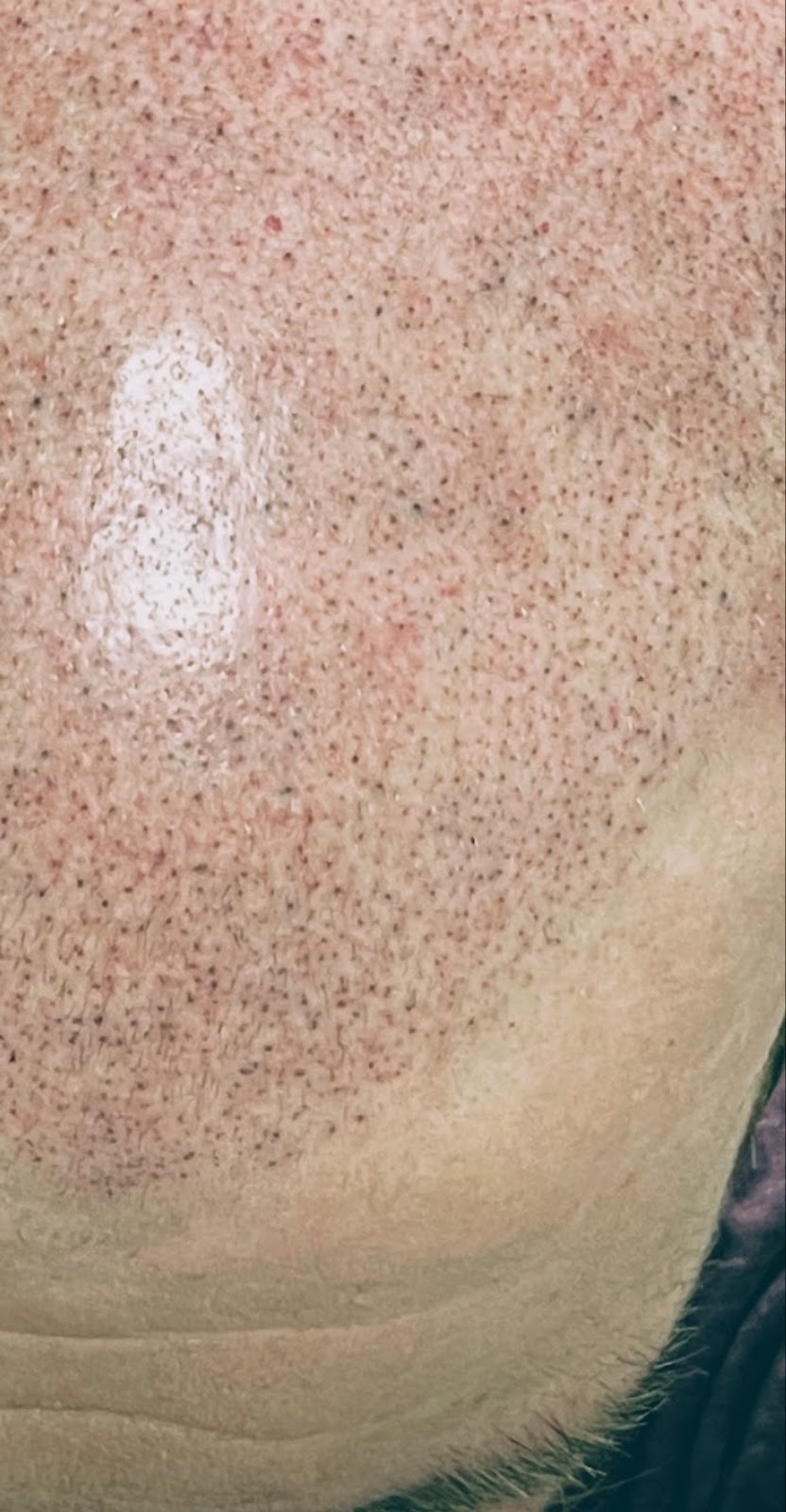 New You Ink Scalp Micropigmentation and Aesthetics | 1348 Sharon Copley Rd, Wadsworth, OH 44281, USA | Phone: (216) 626-5311