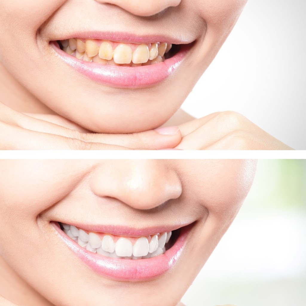 Smile White Now | 5850 Eubank Blvd NE Suite B42, Albuquerque, NM 87111, USA | Phone: (505) 508-5377