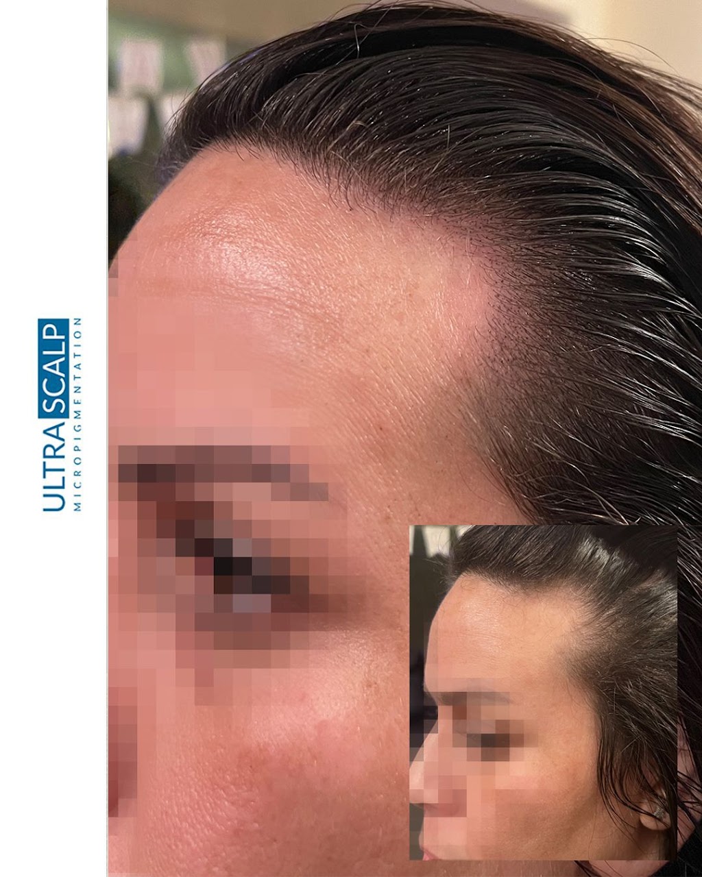 Ultra Scalp Micropigmentation | 4971 Van Dyke Rd, Lutz, FL 33558, USA | Phone: (813) 906-8696