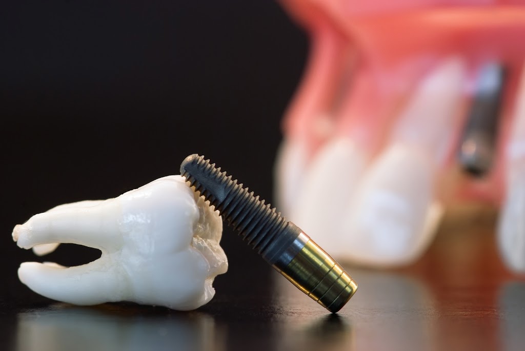 Mini Dental Implants | 90 State St #673, Albany, NY 12207, USA | Phone: (518) 250-6801