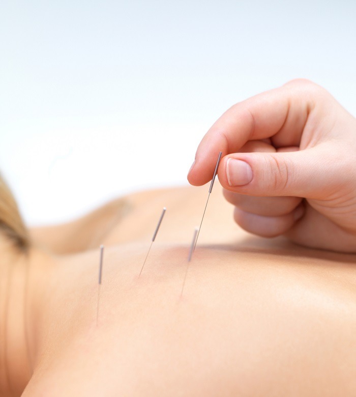 EastOne Acupuncture | 4951 Lincoln Ave, Cypress, CA 90630, USA | Phone: (562) 292-7572