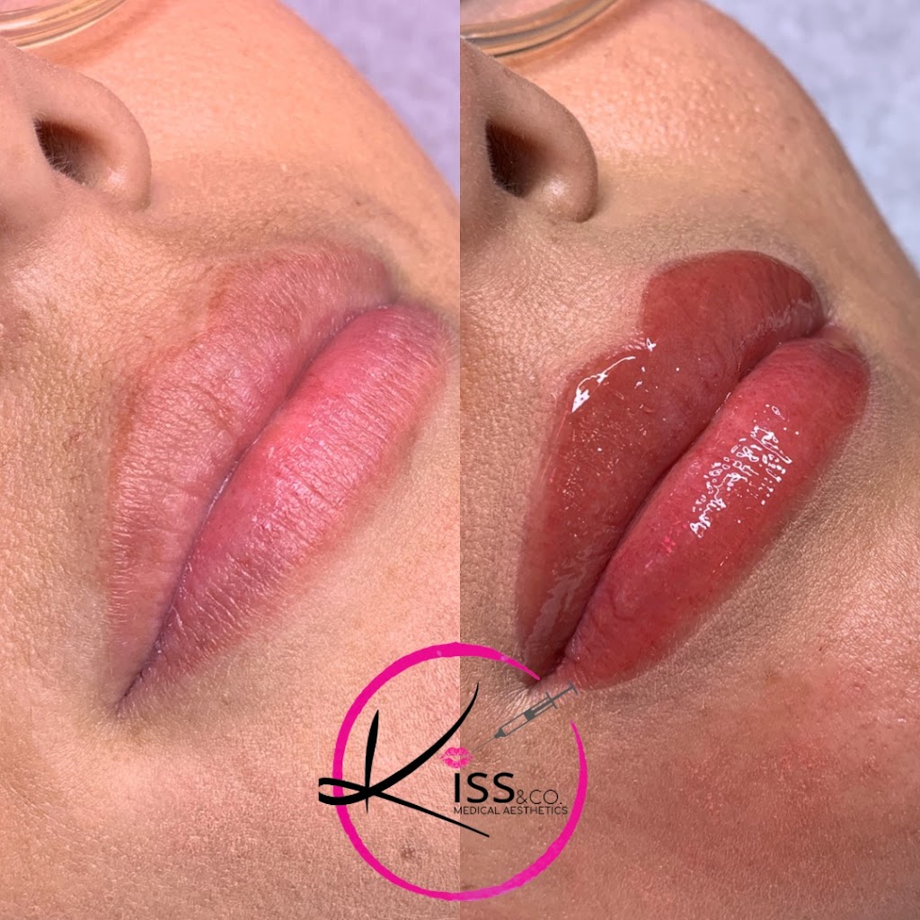 KISS Medical Aesthetics | 1081 Imperial Crescent, Windsor, ON N9G 2T4, Canada | Phone: (226) 350-1582